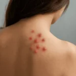 bultjes-door-bedwantsen